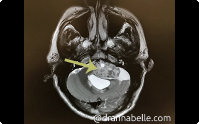 Large left inner ear tumour (acoustic neuroma) which has grown to compress the brain